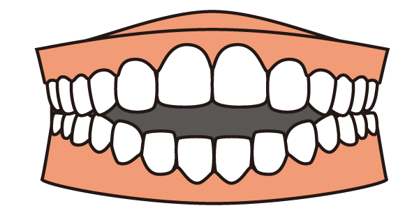 前歯が閉じない状態のイラスト