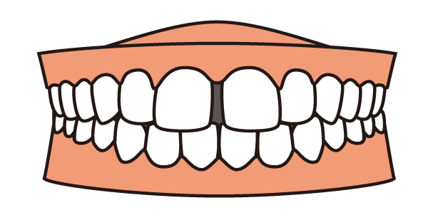 すきっ歯のイラスト