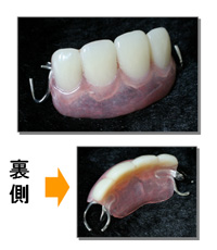 入れ歯(プラスチック床)の写真