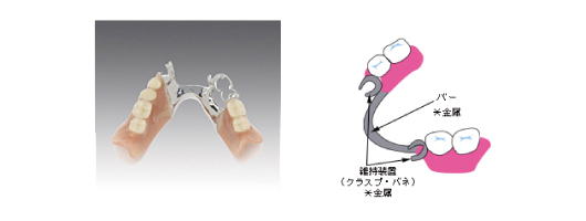 保険の部分入れ歯
