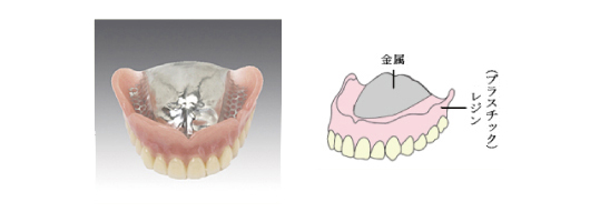 金属床入れ歯の写真