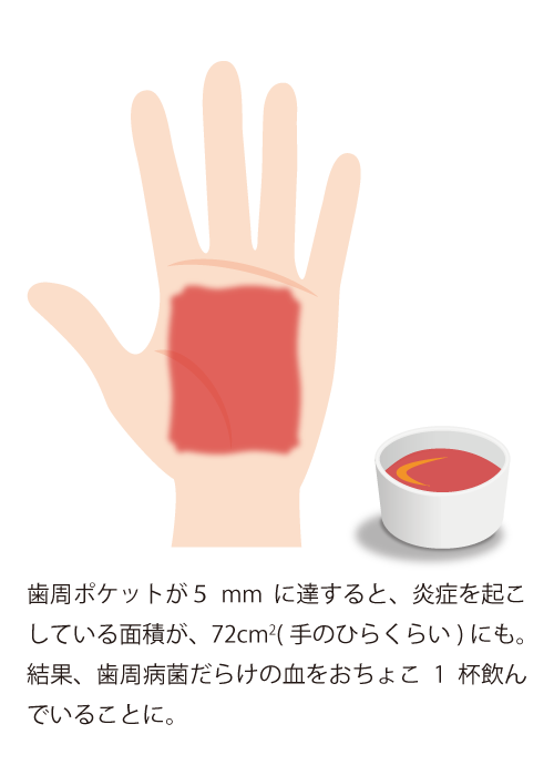 歯周ポケットが5mmに達すると、炎症を起こ
している面積が、72cm?(手のひらくらい)にも。 結果、歯周病菌だらけの血をおちょこ1杯飲ん
でいることに。