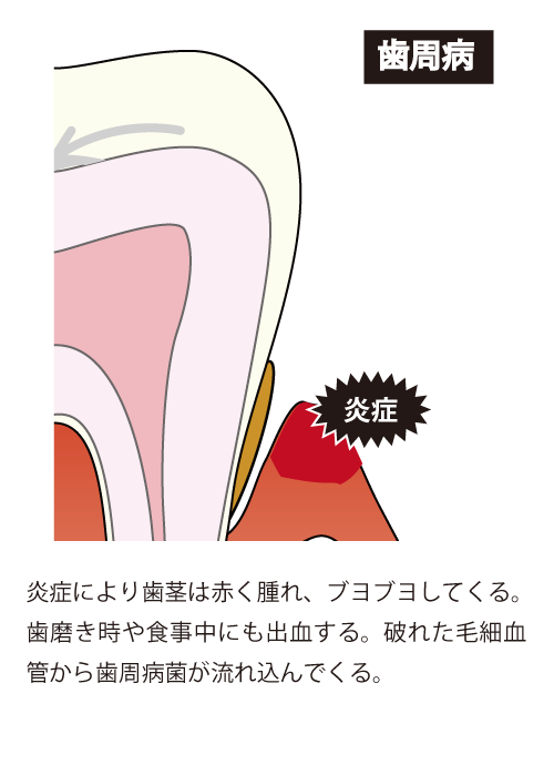 炎症により歯茎は赤く腫れ、ブヨブヨしてくる。
歯磨き時や食事中にも出血する。破れた毛細血管から歯周病菌が流れ込んでくる。