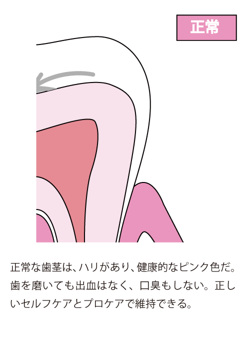 正常な歯茎は、ハリがあり、健康的なピンク色だ。
歯を磨いても出血はなく、口臭もしない。正しいセルフケアとプロケアで維持できる。